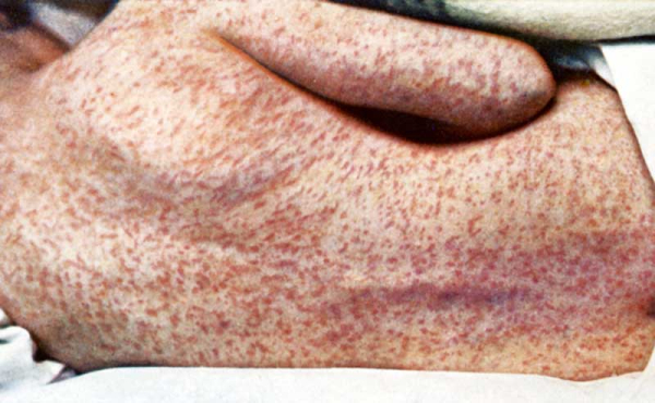 a person with measles