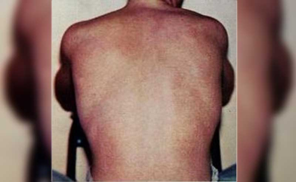 a person's back with dengue